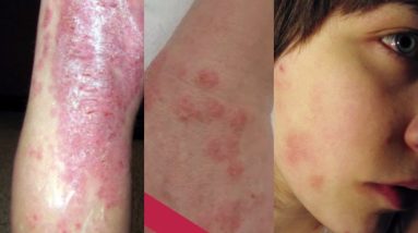 9 Foods to avoid with Eczema 16 1680913751 maxresdefault