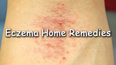 How To Cure Eczema / Home Remedies For Eczema Treatment by Sachin Goyal @ ekunji.com 12 1680913961 maxresdefault