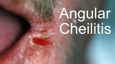 THE PAINFUL LIP - ANGULAR CHEILITIS 6 1680916618 maxresdefault