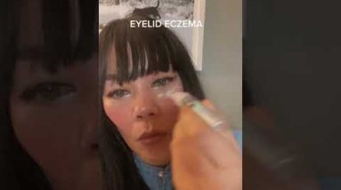 Eyelid Eczema Tips #shorts #eczema #eyecare #eyes #shortsfeed 4 1680917424 hqdefault