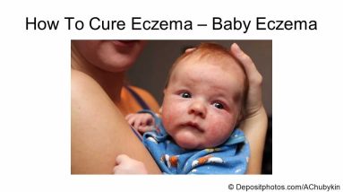 How to cure baby eczema - cure for baby eczema 20 1680928566 maxresdefault