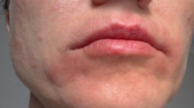 how to get rid of eczema on face at home 12 1680930755 maxresdefault