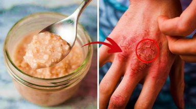 How To Cure Eczema Naturally And Permanently, How To Treat Eczema At Home Naturally 14 1680940344 maxresdefault