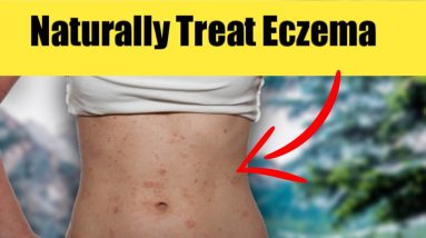 Natural Remedy for Eczema - Eczema Treatment Natural Cure 16 1680945666 maxresdefault