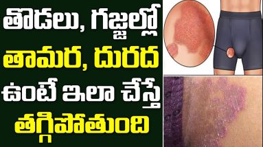 How to Treat Fungal Infections Ringworm inTelugu I Eczema Treatment || Dr Madhavi | SumanTV 6 1680947933 maxresdefault
