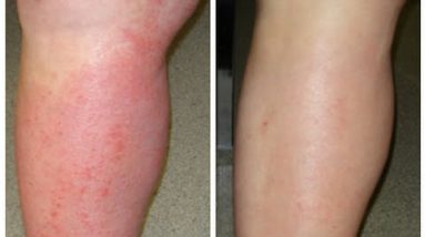 4 Natural Cures for Eczema : How to Cure Eczema Fast! 20 1680966070 hqdefault
