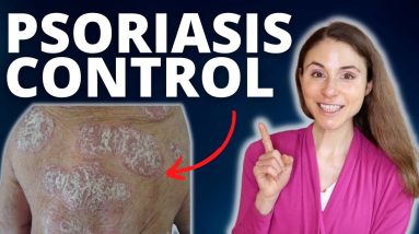 TOP 5 TIPS TO CONTROL PSORIASIS FLARES 😊 DERMATOLOGIST @DrDrayzday 12 1680967930 maxresdefault