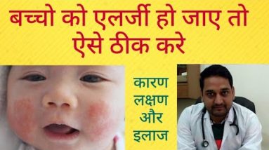 allergic dermatitis or eczema cause, symptoms and treatment 20 1680971291 hqdefault