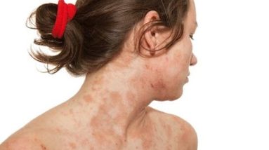 Eczema Treatment Guide : What is Eczema and Tips To Get Rid of Eczema mp4 12 1680973710 hqdefault