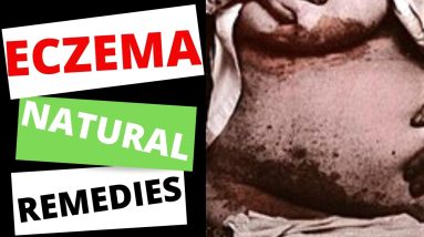 How To Relieve Eczema Itchy Skin Using All Natural Remedies 8 1680974135 maxresdefault
