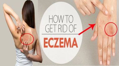 How to Get Rid of Eczema at Home || Home Remedies for Eczema Treatment || Itchy Skin Relief 4 1680975543 maxresdefault