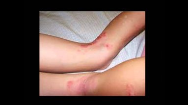 Eczema Pictures 18 1680977360 maxresdefault