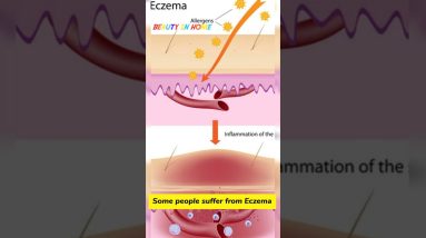 causes of eczema skin disease एग्जिमा के क्या लक्षण होते हैं ? #shorts #beautyinhome #skincare 14 1680977778 maxresdefault