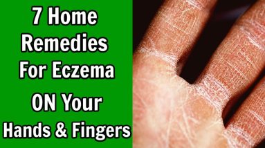 7 Home Remedies For Eczema on Hands And Fingers 10 1680979182 maxresdefault