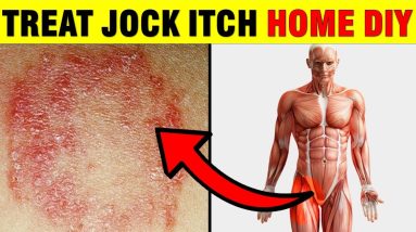 BEST Groin Fungal Infection Remedies - JOCK ITCH TINEA CRURIS 8 1680979492 maxresdefault
