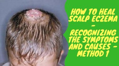 How to Heal Scalp Eczema - Recognizing the Symptoms and Causes - Method 1 20 1680981632 maxresdefault