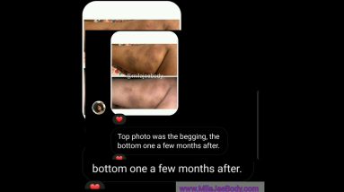 How I Healed My Eczema NATURALLY | Before And After 12 1680983871 maxresdefault