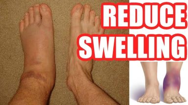 How to Reduce Swelling: Make Your Swelling Go Down Easy Methods 20 1680987079 maxresdefault