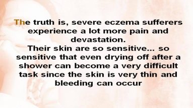 Dermatitis Treatment | Eczema Cure and Treatments 12 1680989071 maxresdefault