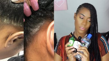 Update: How I control my seborrheic dermatitis, flakes,eczema,& psoriasis? How did I know ? 6 1680996399 maxresdefault