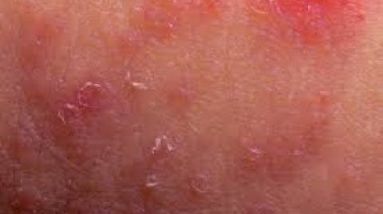 what triggers eczema outbreaks - trigger factors for eczema 4 1680996855 hqdefault