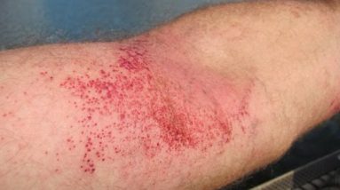 Experience Sharing of Successful Treatment In Allergic Eczema 2 1681008095 hqdefault