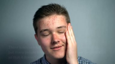 How To Treat Eczema Naturally - A Home Remedy For Eczema | BioHacker 8 1681011849 maxresdefault