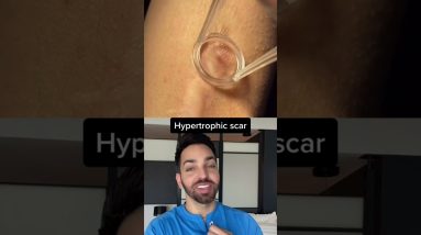 Dr. Shah Reacts to Scar Treatment #shorts 4 1681012805 maxresdefault