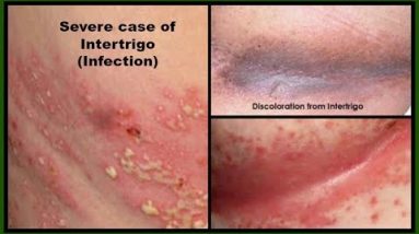 HOW TO TREAT UNDER BREAST RASHES + INFECTION NATURALLY IN 4 EASY STEPS | INTERTRIGO |Khichi Beauty 2 1681012953 hqdefault