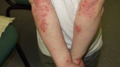 is it possible to get rid of eczema – cure eczema for good 20 1681019481 hqdefault