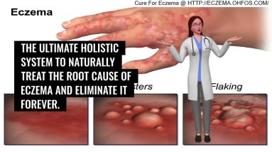How To Treat Eczema With Aloe Vera 6 1681023211 maxresdefault