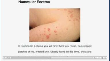 How To Get Rid Of Eczema ... How To Cure Eczema Naturally 12 1681026875 hqdefault