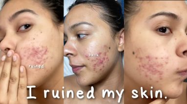 I Ruined My Skin with this Beauty Hack... #shorts #skincare 8 1681028505 maxresdefault