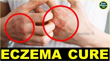 How To Get Rid of Eczema Permanently | Natural Eczema Treatment 2 1681029390 maxresdefault