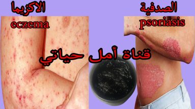 The most powerful treatment to eliminate psoriasis and eczema 8 1681033061 maxresdefault
