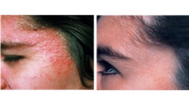 How to Deal with Eczema from the Inner Out | Eczema Home Treatment 100% Guranteed Permanently cure 10 1681038262 maxresdefault
