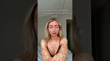 What Is Psoriasis? #shorts 4 1681038654 maxresdefault