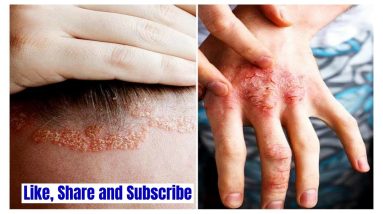 एग्ज़ीमा का अचूक घेरलू उपाय, Eczema Treatment | Causes of Eczema 16 1681042000 maxresdefault