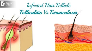 Infected hair follicle. What to do? Causes, Location, & Treatment-Dr. Rasya Dixit | Doctors' Circle 20 1681046114 maxresdefault