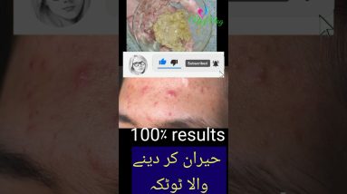 Common skin diseases treatment | skin problems, Eczema Psoriasis Acne Pimples #short #skincare 12 1681047834 maxresdefault