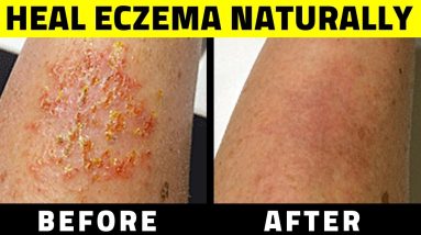 How to treat eczema naturally at home 16 1681053678 maxresdefault