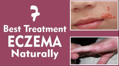7 Ways to Cure Eczema With Natural Ingredients 4 1681055182 maxresdefault