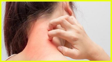 Dandelions Help Treat Eczema According to Study 6 1681072654 maxresdefault