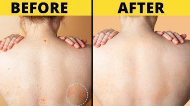 ECZEMA TREATMENT IN 2021 | ITCHINESS | ALLERGIES | SILVA GUIDE | 4 1681076314 maxresdefault
