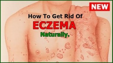 How To Get Rid of Eczema Naturally : Top 5 Home Remedies For Eczema 6 1681081547 hqdefault