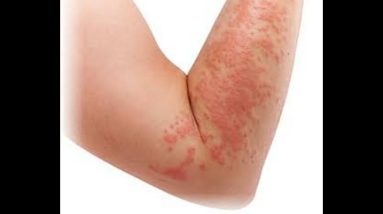 Eczema and psoriasis treatment natural home remedies Urdu Hindi||Anum Punjabi 2 1681083118 maxresdefault