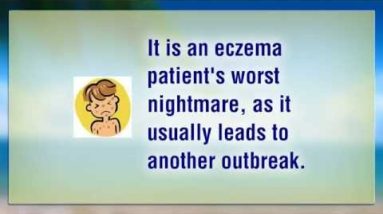 How To Treat Eczema: Bathing Tips For Eczema Sufferers 20 1681083299 hqdefault