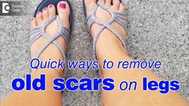 How to remove old scars on legs fast? - Dr. Rasya Dixit 20 1681083645 maxresdefault