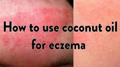 How to use coconut oil for eczema - best eczema treatment 8 1681086830 maxresdefault