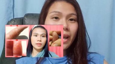 ALIPUNGA,BUNI,ECZEMA,GALIS ATBP SKIN ALLERGY|FUNGISOL REVIEW|ALGENS VLOGGS 2 1681087756 maxresdefault
